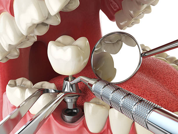 Best Emergency Tooth Extraction in Perry, MI